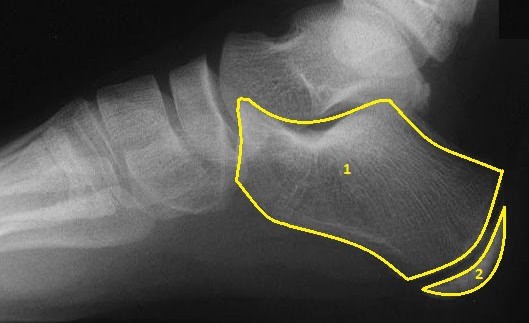 Xray of a Child's Foot