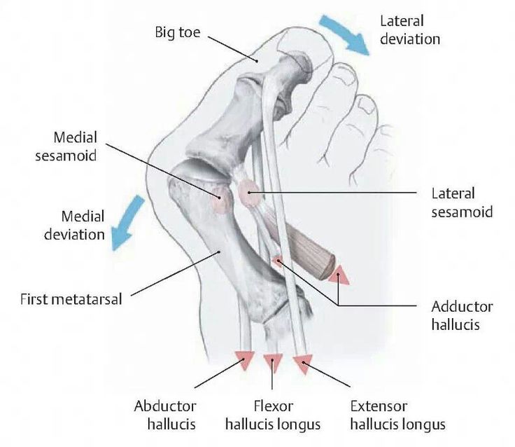 Bunions Treatment Northcote