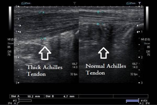 Diagnosis of Achilles Tendinopathy