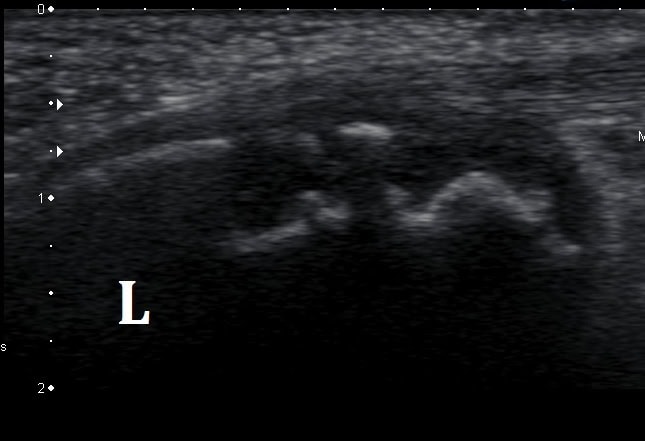 Diagnosis of Severs Disease