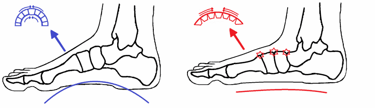 Dorsal Midfoot compression