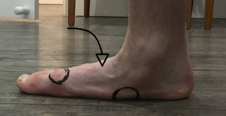 Flat Feet Northcote