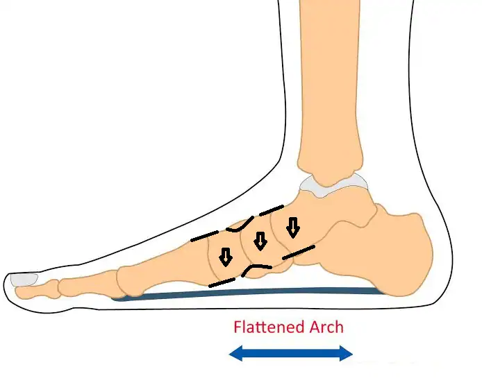 Flat Feet Treatment Northcote