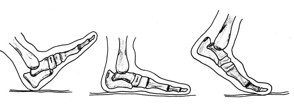 Flat-foot Pes Planus Gait bones