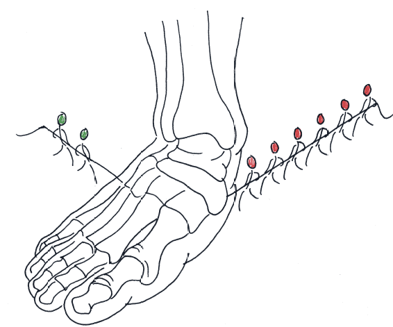 Flat foot muscle balance