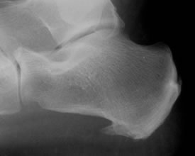 Heel Spurs Northcote