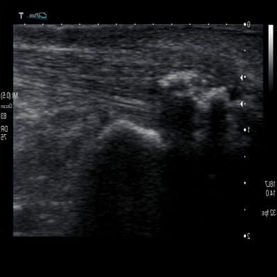 Insertional Achilles Tendon