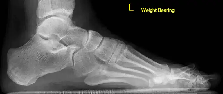 Normal left foot