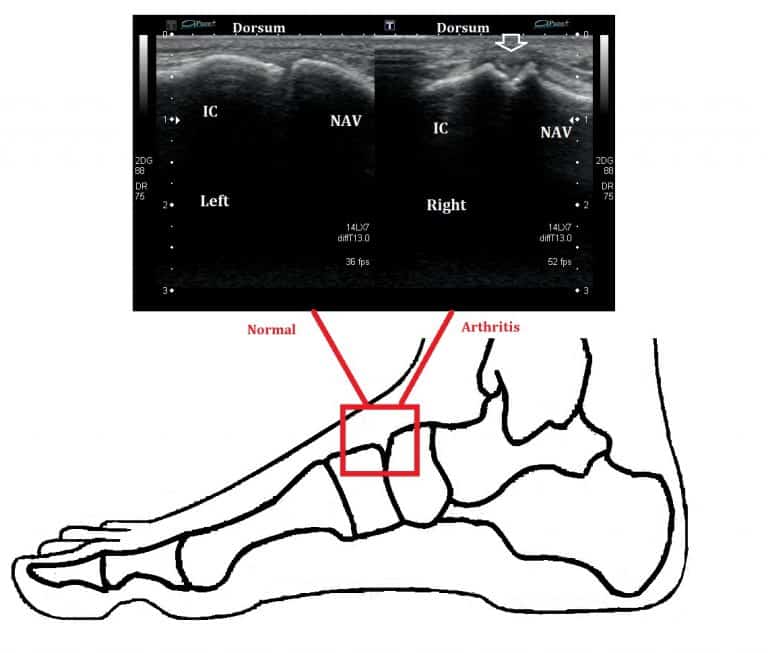 Midfoot Arthritis X-ray