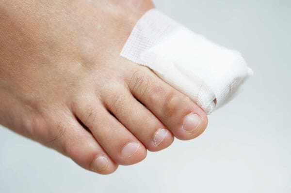 Nail Surgery Procedure Northcote