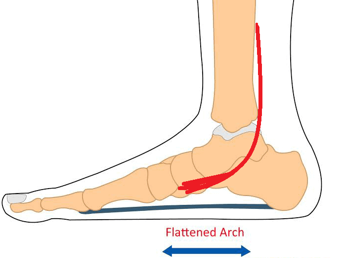 Northcote Flat Feet Treatment