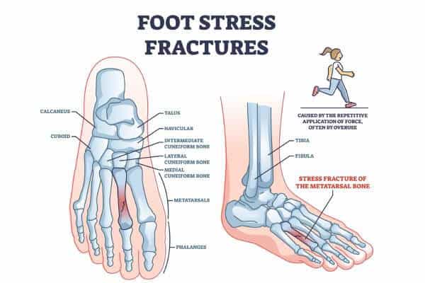 Northcote Fracture Management