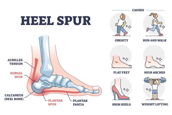 Northcote Heel Spurs
