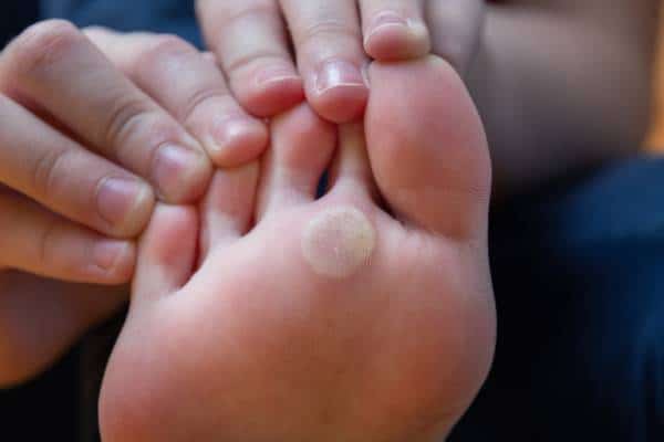 Northcote Plantar Wart Treatment