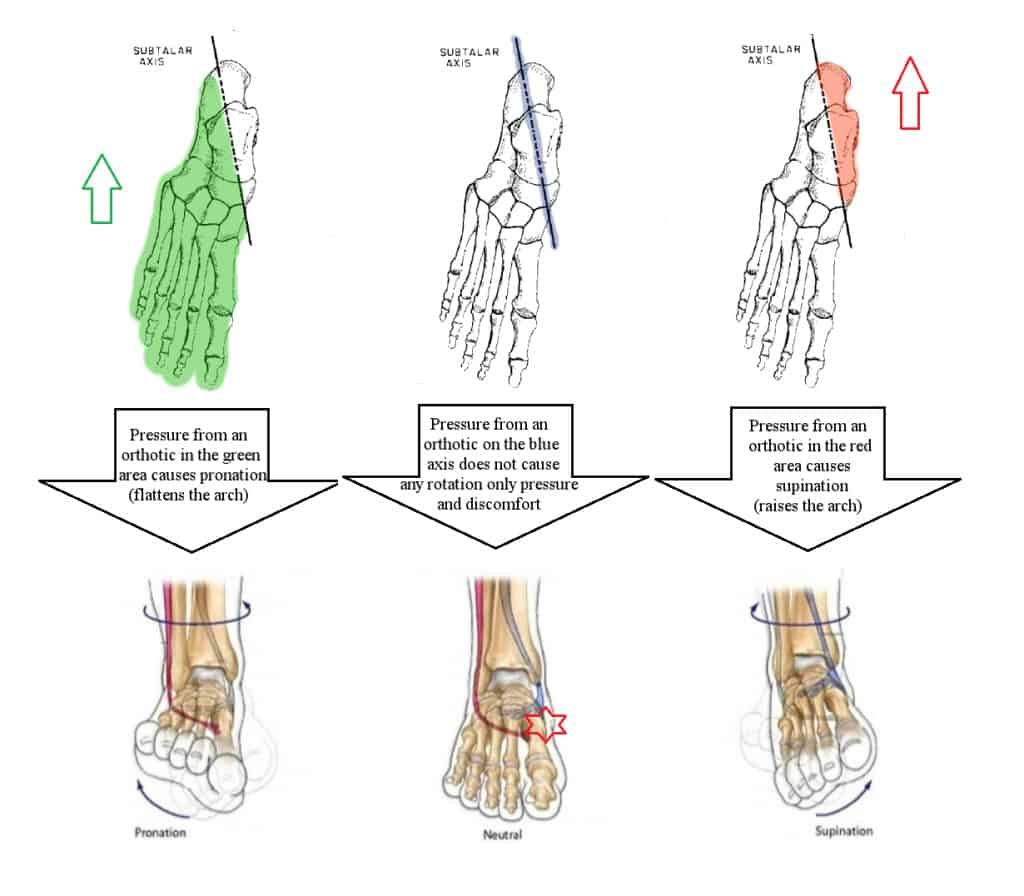 Orthotic Treatment of flat feet