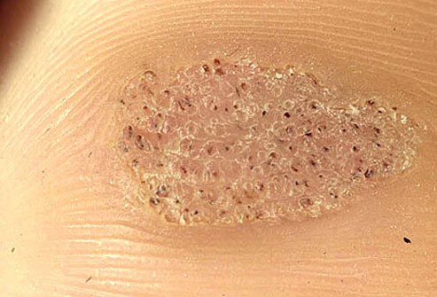 Plantar Wart Northcote