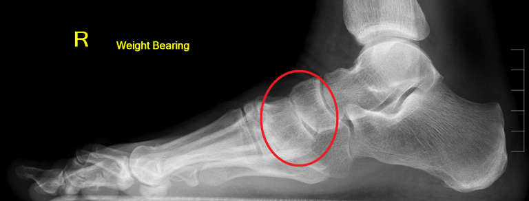 Moderate arthritis of the joint of the navicular and medial cuneiform