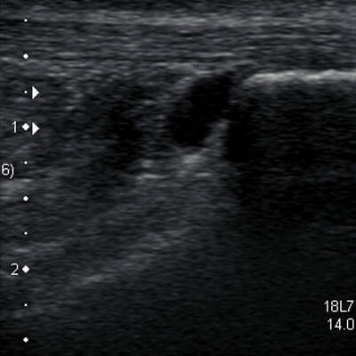 Retrocalcaneal Bursitis