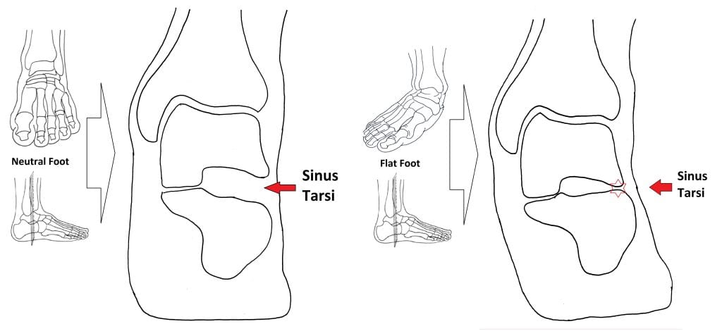 Sinus Tarsi Syndrome