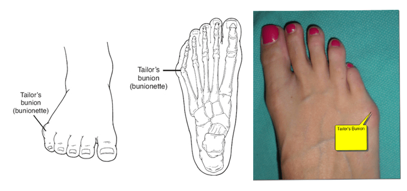 Tailors Bunion Northcote