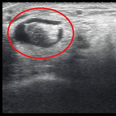 Tibialis posterior tendon
