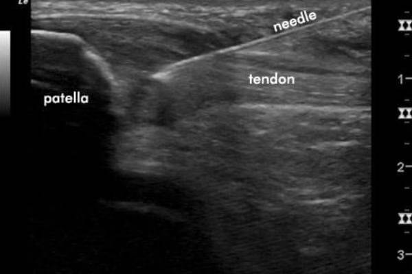 Ultrasound Guided Tendon Fenestration