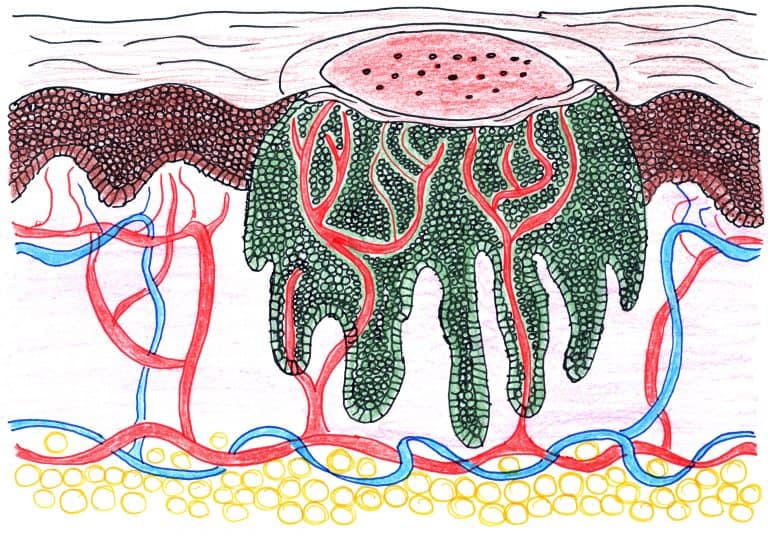 Illustration of wart skin