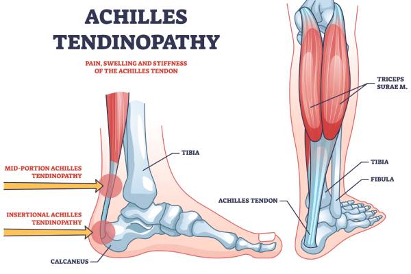 Achilles Diagram